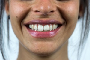 ortodonzia-Chimetto-Filice-dentista-a-Pisa